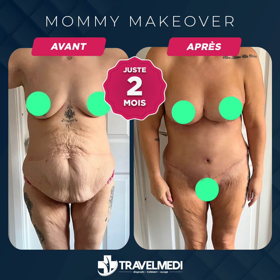Résultats après Mommy Makeover en Turquie Mommy Makeover avant après en Turquie