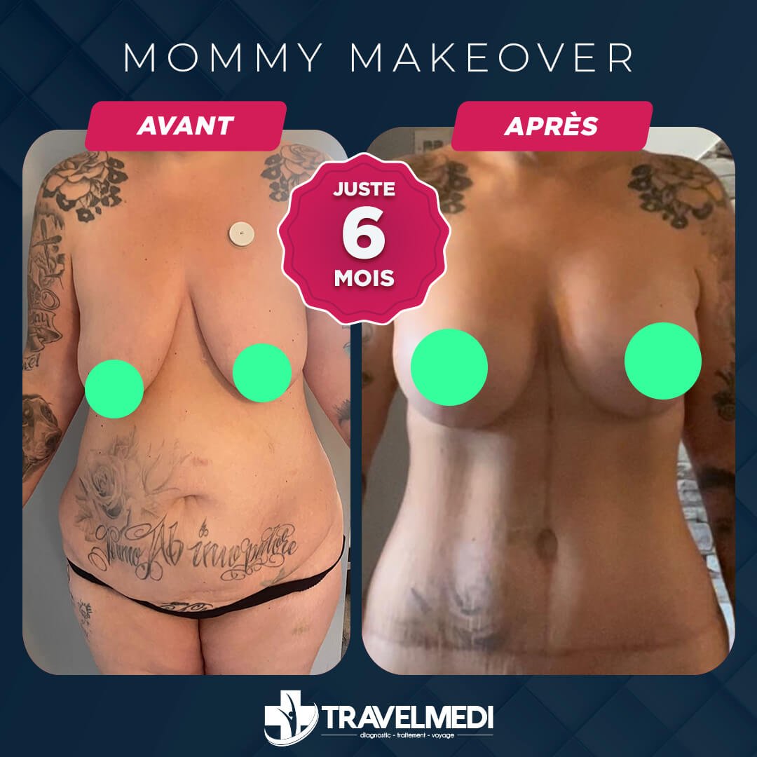 Résultats après Mommy Makeover en Turquie Mommy Makeover avant après en Turquie