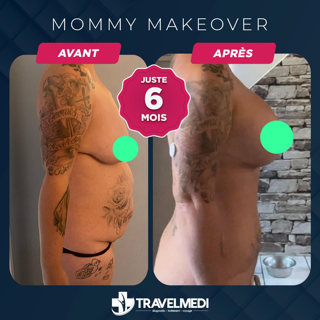 Résultats après Mommy Makeover en Turquie Mommy Makeover avant après en Turquie