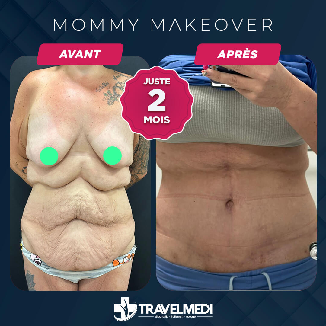 Résultats après Mommy Makeover en Turquie Mommy Makeover avant après en Turquie
