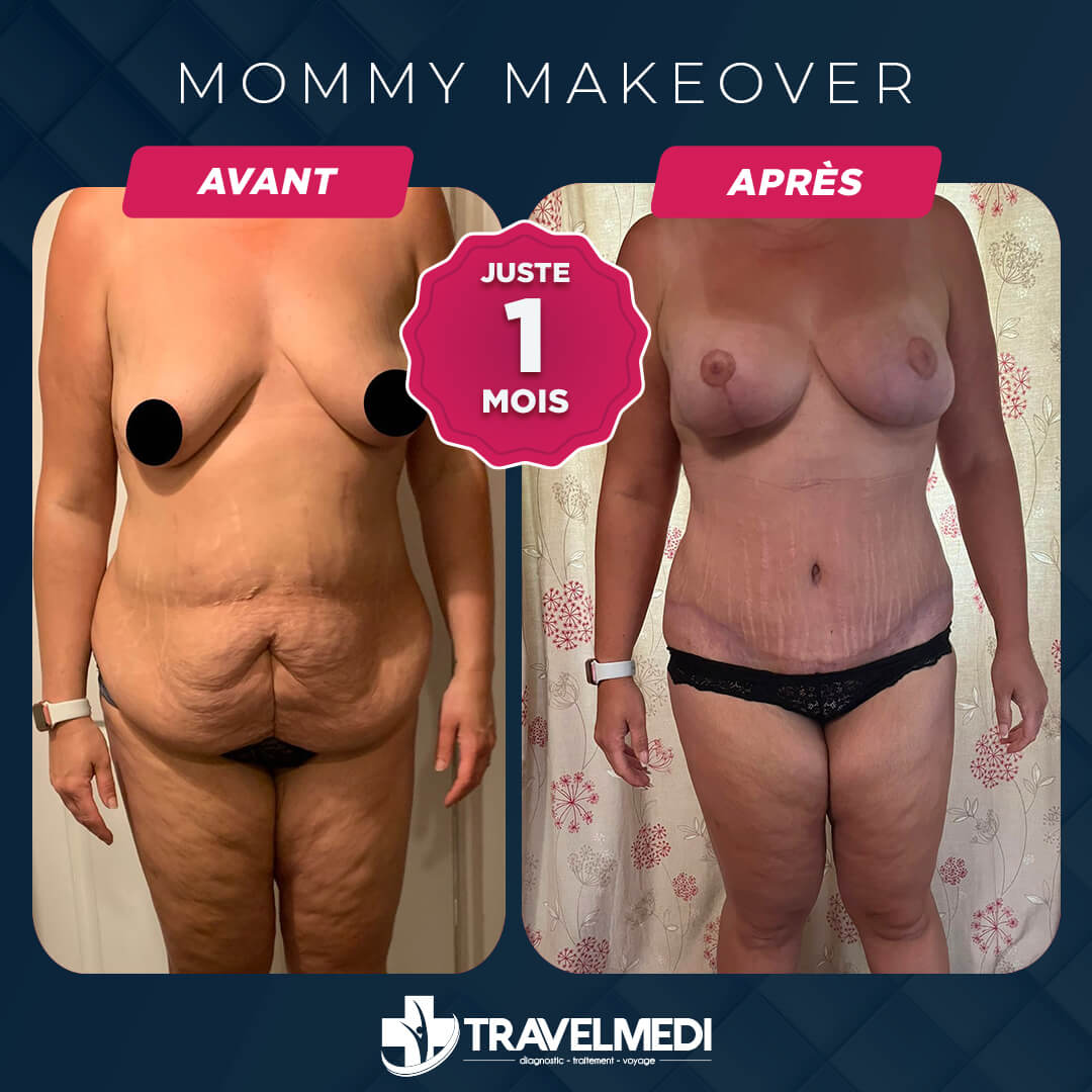 Résultats après Mommy Makeover en Turquie Mommy Makeover avant après en Turquie