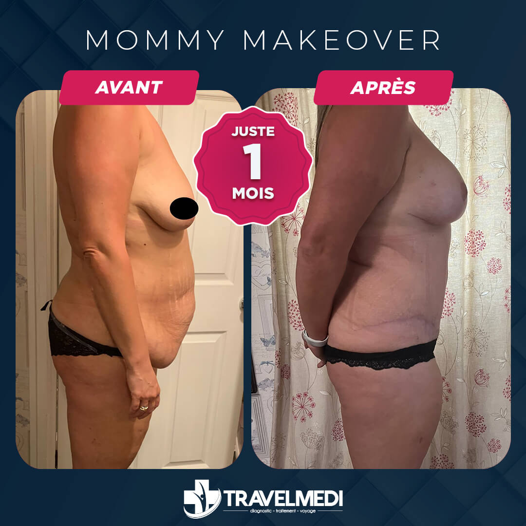 Résultats après Mommy Makeover en Turquie Mommy Makeover avant après en Turquie